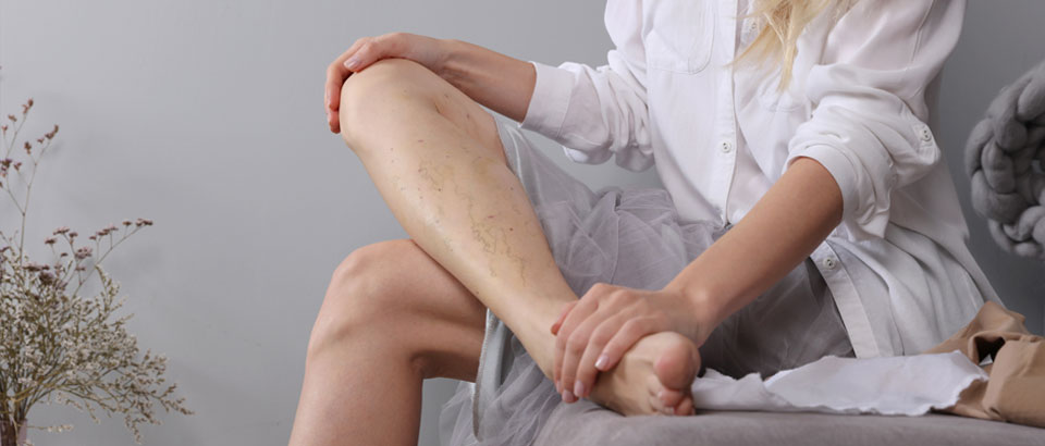 woman with veins on her leg